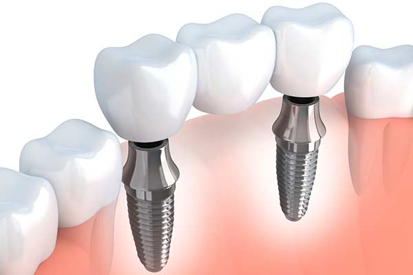 Implant supported bridge