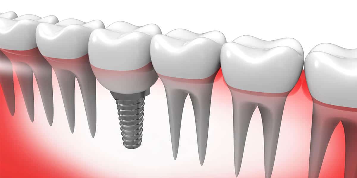 Singel tooth implants